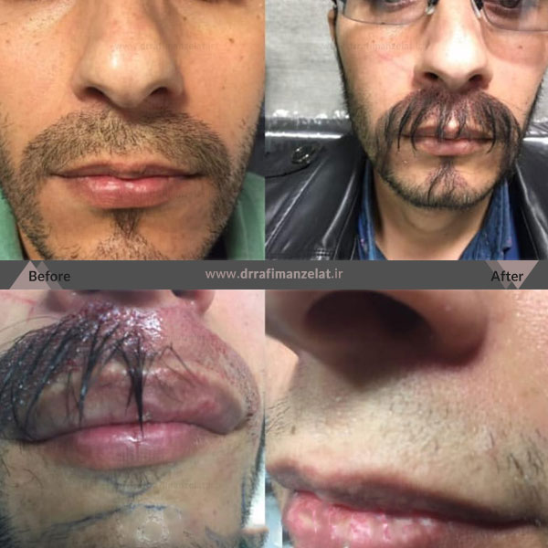 عکس کاشت ریش و سبیل قبل و بعد