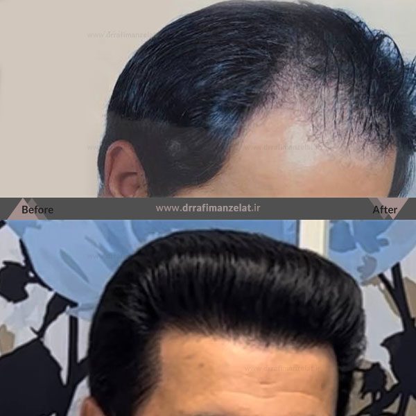 کاشت مو با تراکم بالا در شاهین شهر اصفهان 