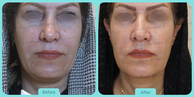 مرکز تخصصی اندولیفت در اصفهان