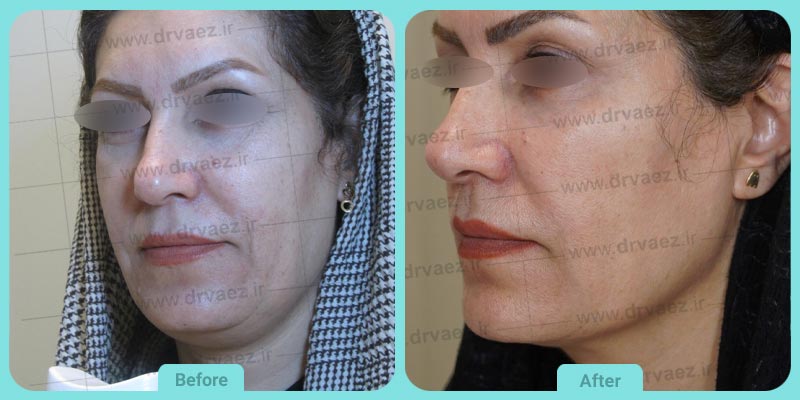 بهترین مرکز لیزر اندولیفت در اصفهان