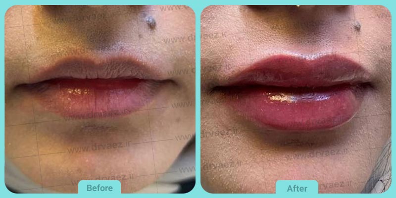 عکس تزریق ژل لب قبل و بعد (6)