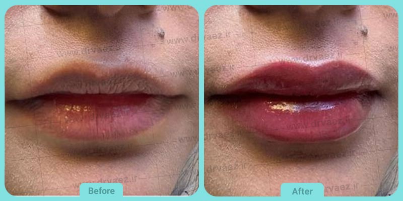 عکس تزریق ژل به لب قبل و بعد (9)
