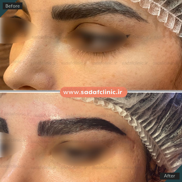 بهترین کلینیک کاشت ابرو در اصفهان