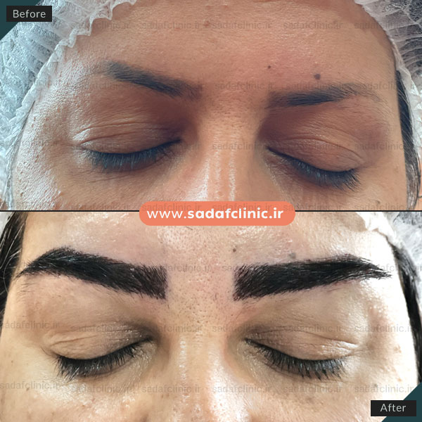 کاشت ابرو در اصفهان