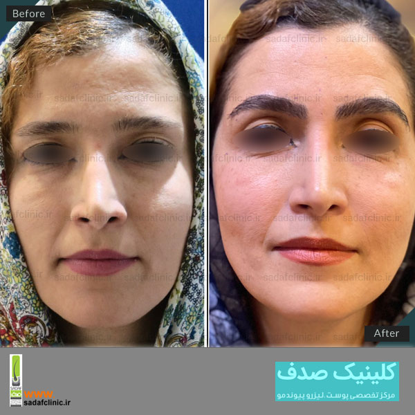 بهترین مرکز کاشت ابرو در اصفهان