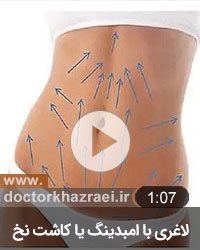 لاغری شکم و پلهو با کاشت نخ امبدینگ