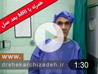 ویدئوی شماره 75-دیسک اکسترود L5S1 درمان با لیزر پلاسما، مقایسه MRI بیش از یکسال بعد از عمل