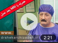 ویدئوی شماره 146- دیسک اکسترود L4L5 چپ، درمان با لیزر پلاسما، ویدیو و MRIسه سال بعد عمل