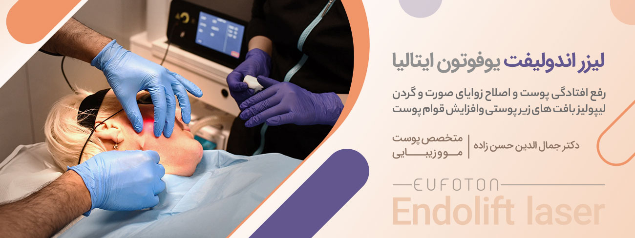 لیزر اندولیفت یوفوتن ایتالیا