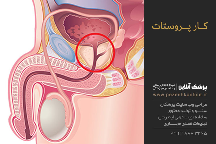 کار پروستات چیست؟