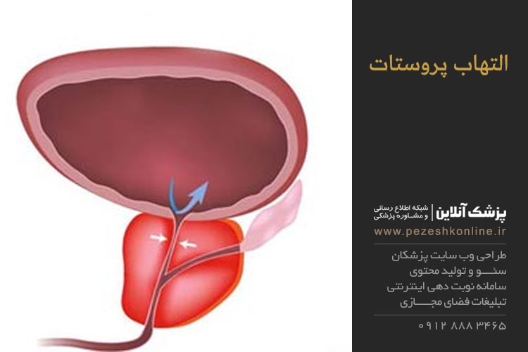 درمان التهاب پروستات