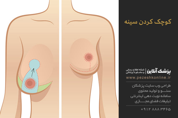 عمل کوچک کردن سینه