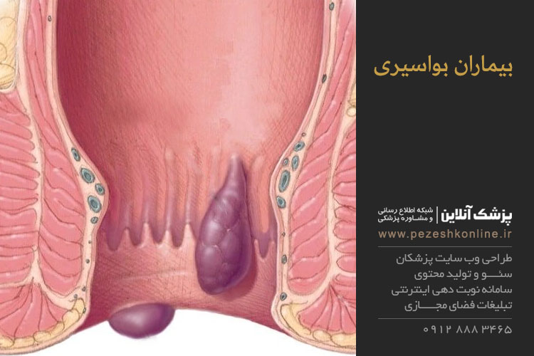 تـوصیـه هایی برای بیماران بواسیری