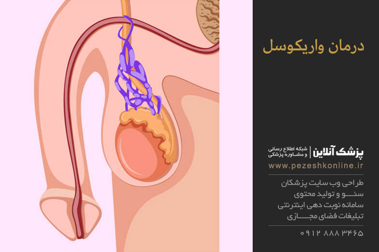 واریکوسل و درمان آن