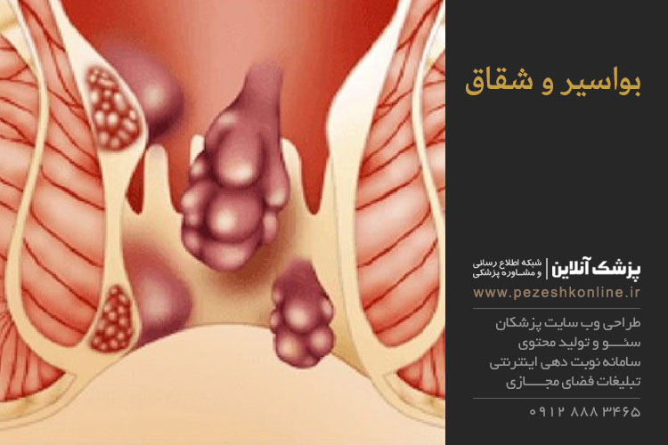 درمان بواسیر