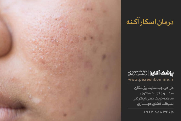 درمان آکنه اسکار یا جای جوش