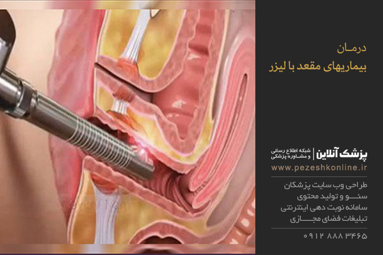 لیزر درمان بیماریهای مقعد