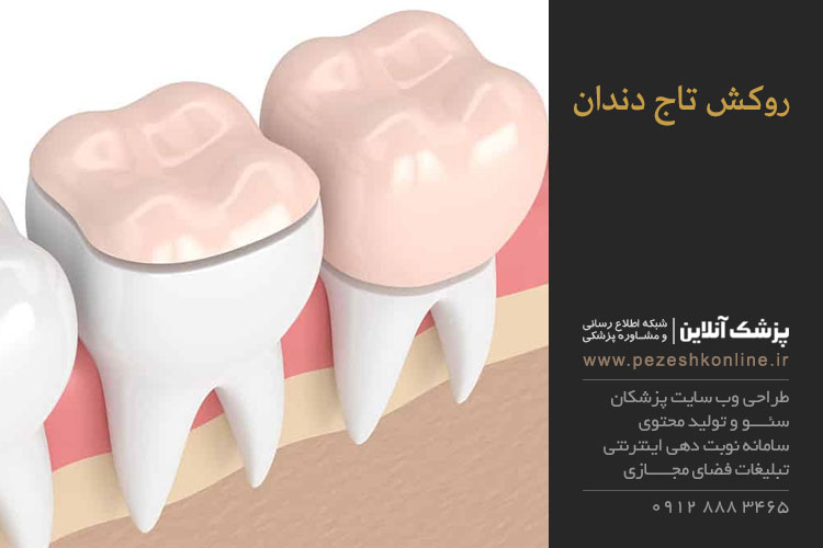 روکش تاج دندان