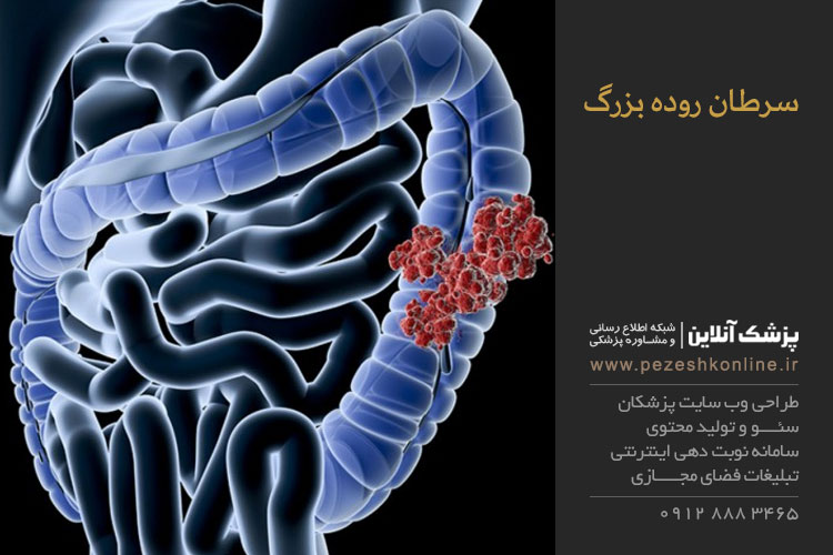 علائم سرطان روده بزرگ