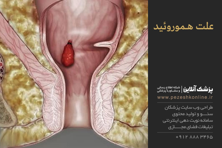 آشنایی با هموروئید