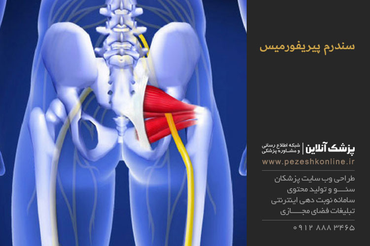 درد عصب سیاتیک