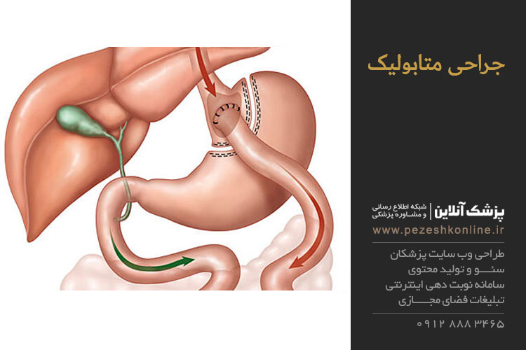 آشنایی جراحی متابولیک