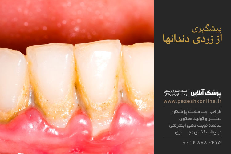 پیشگیری از زردی دندان