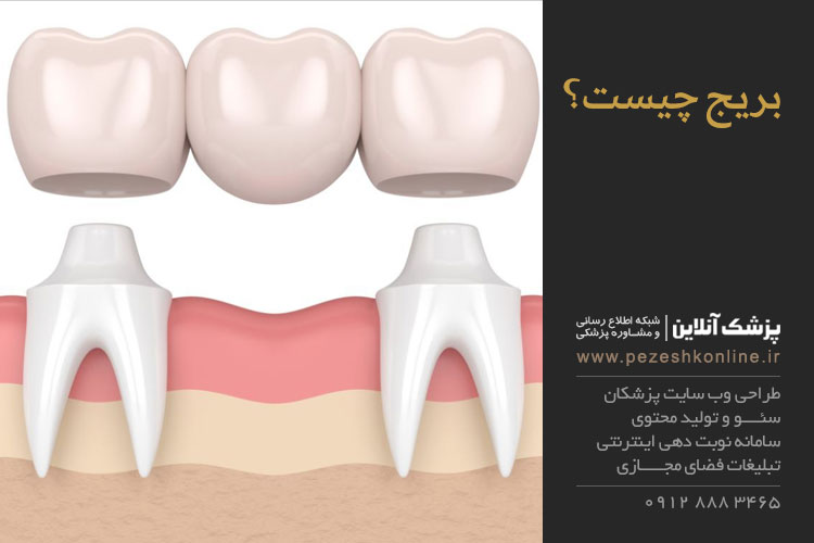 مزایای بریج