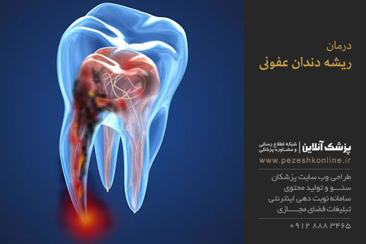 درمان عفونت ریشه دندان