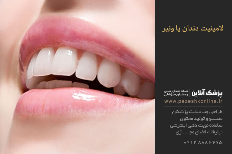 لامینیت دندان یا ونیر چیست