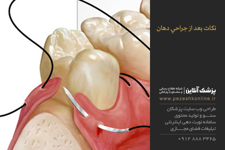 نكات بعد از جراحي دهان