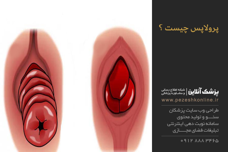 پرولاپس چیست