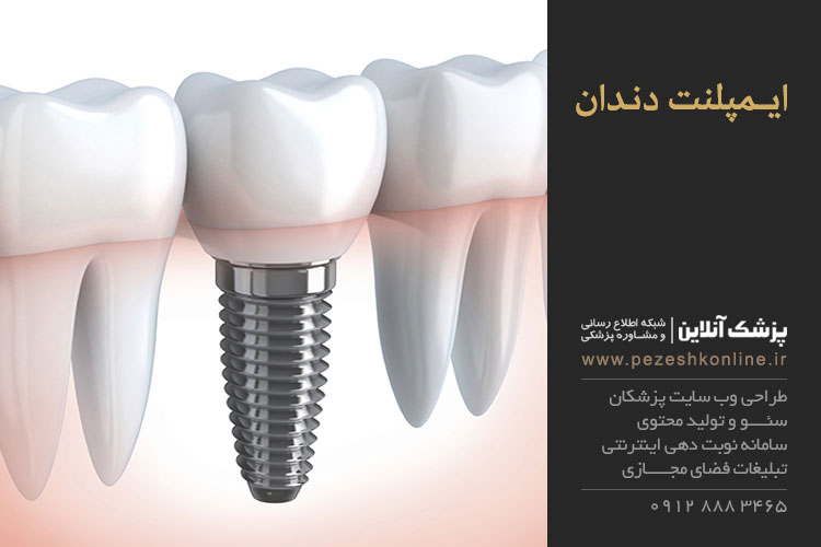 ایمپلنت دندان در تهران