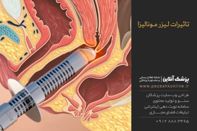 کاربرد لیزر مونالیزا