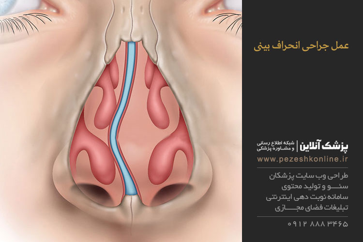 سیتوپلاستی بینی