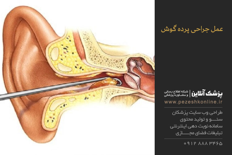 ترمیم پرده گوش با جراحی