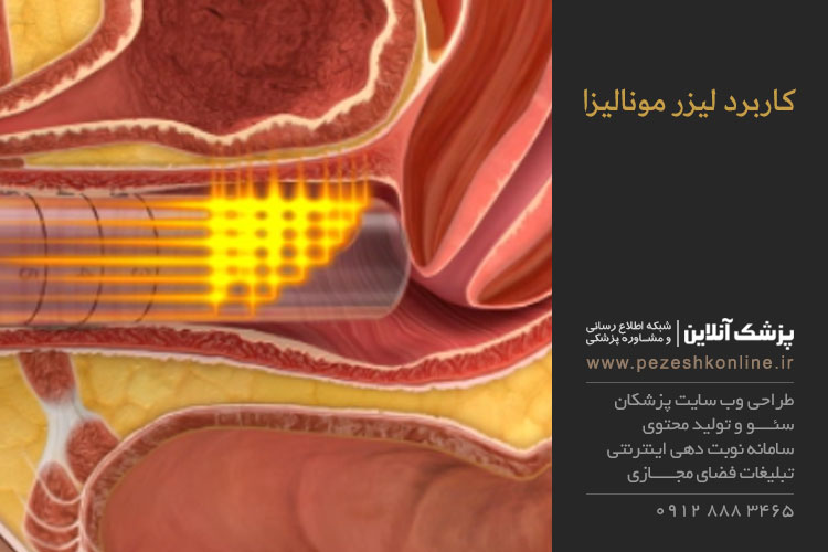 لیزر مونالیزا چیست