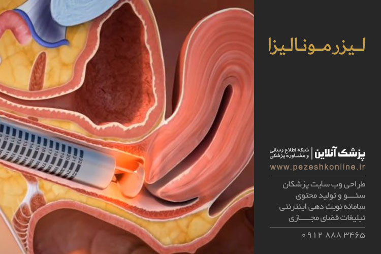 نکات پس از لیزر مونالیزا