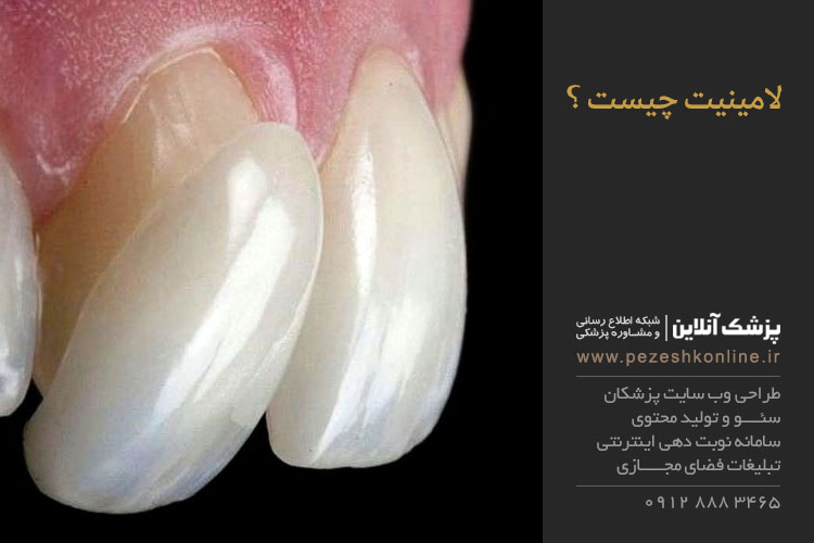 کاربرد لامینیت دندان