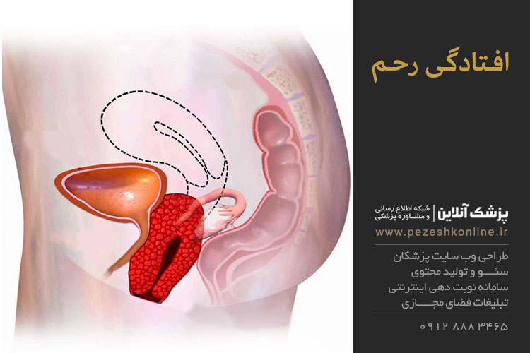 علائم افتادگی رحم چيست ؟