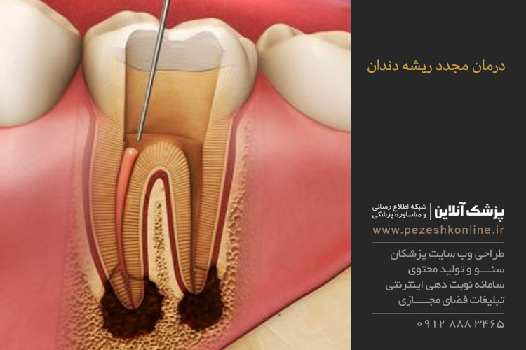 درمان مشکلات ریشه دندان