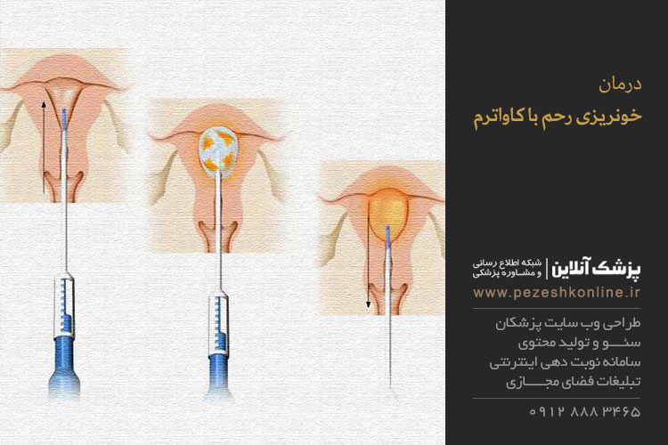 درمان خونریزی رحم با كاواترم