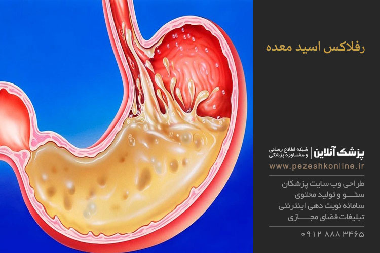 رفلاکس اسید معده