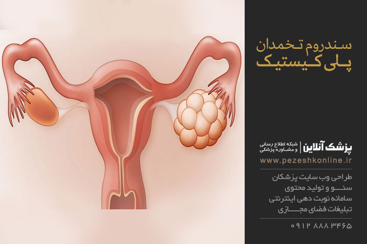 سندروم تخمدان پلی کیستیک