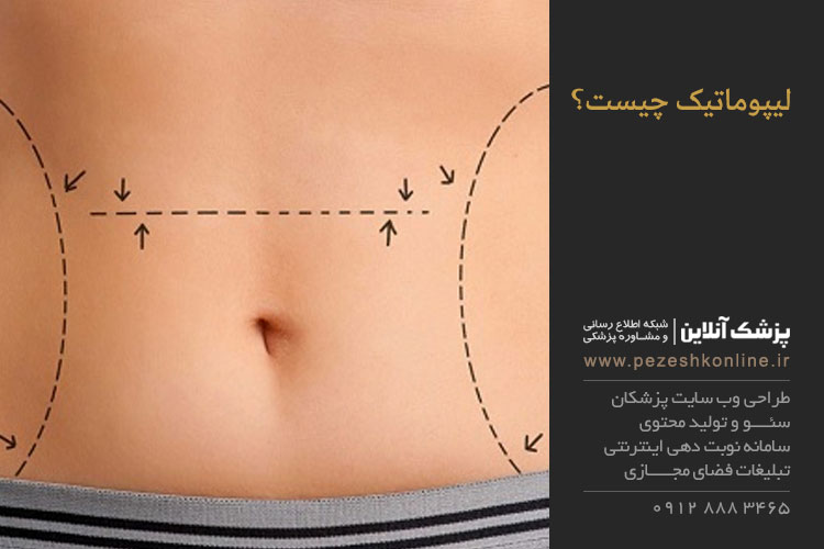 کاهش چربی های بدن با لیپوماتیک