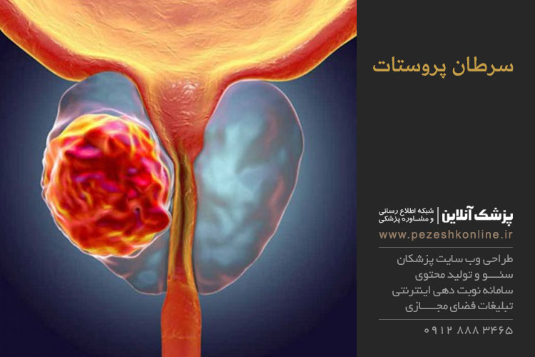 کاهش سرطان پروستات با تغذیه