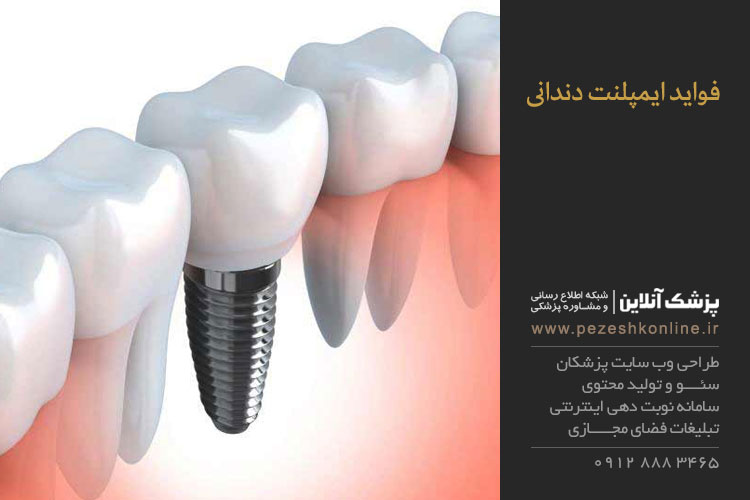 فواید ایمپلنت دندانی