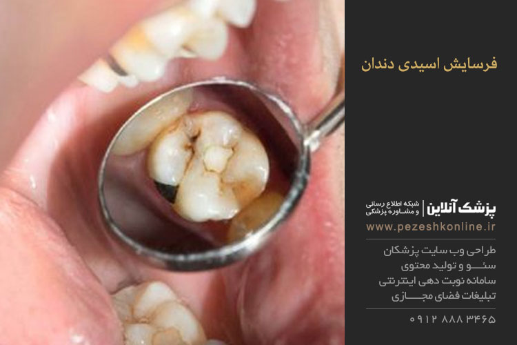 فرسایش اسیدی دندان چیست
