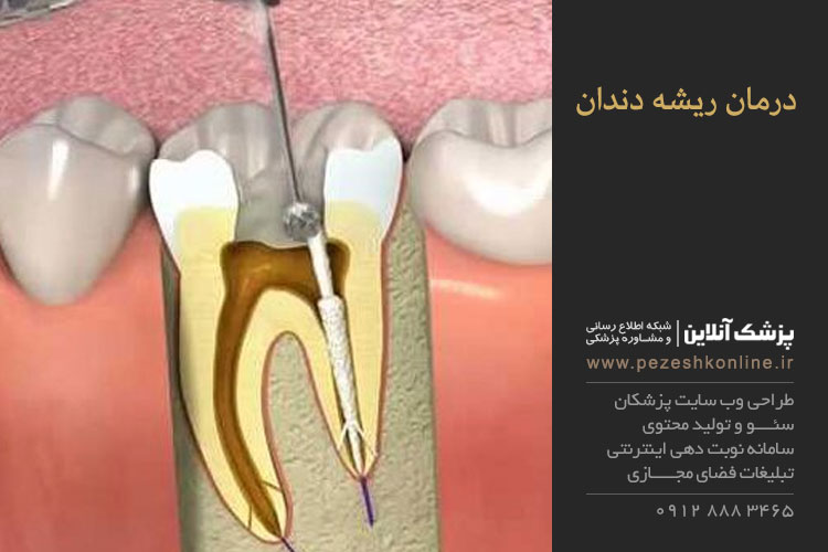 درمان درد ریشه دندان