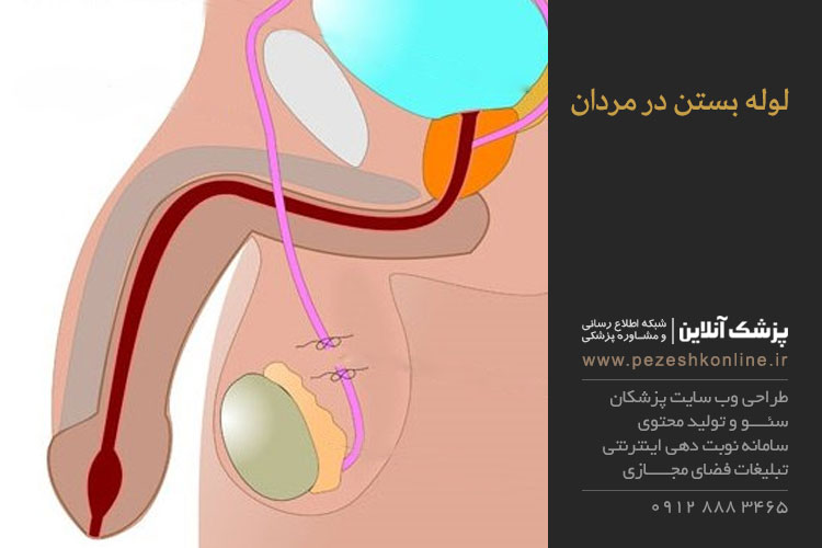 بستن لوله مردان